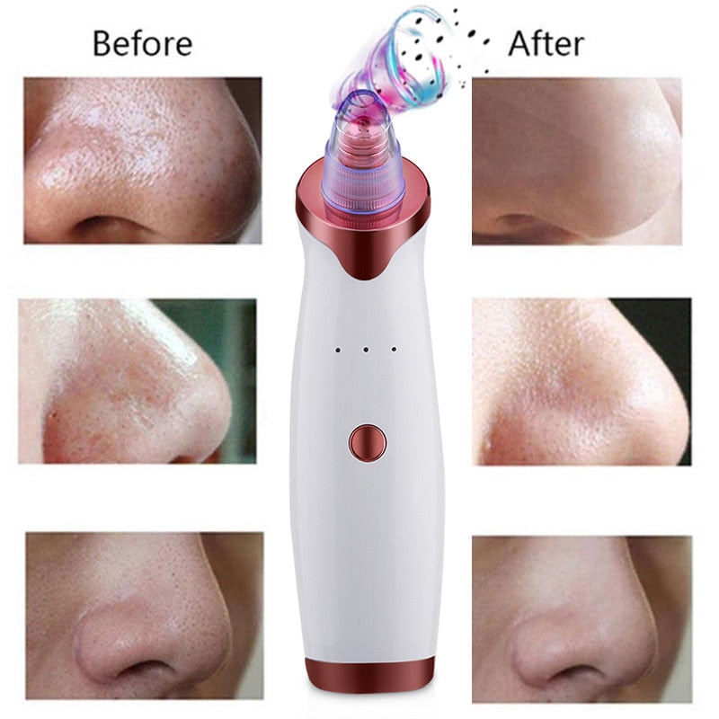 ELECTRIC BLACKHEAD ACNE REMOVER